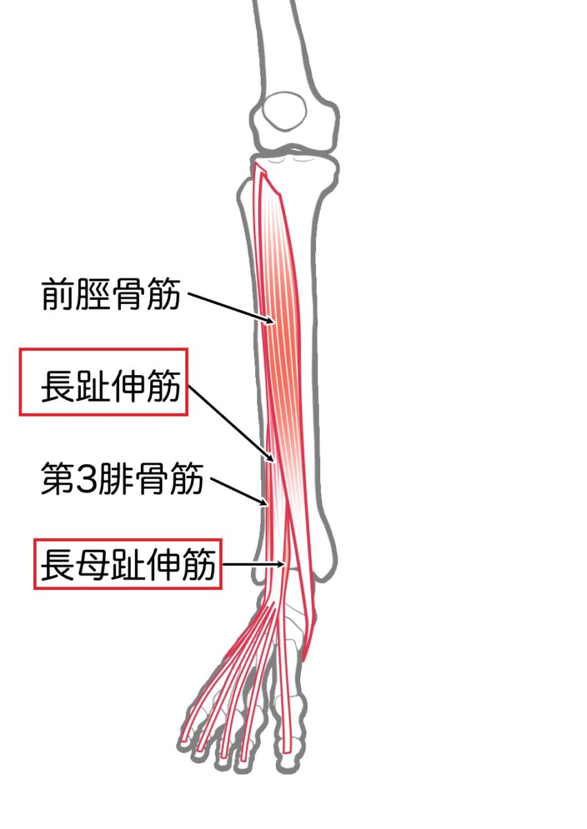 腰椎椎間板ヘルニア　L5神経根障害　長趾伸筋・長母趾伸筋　筋力低下