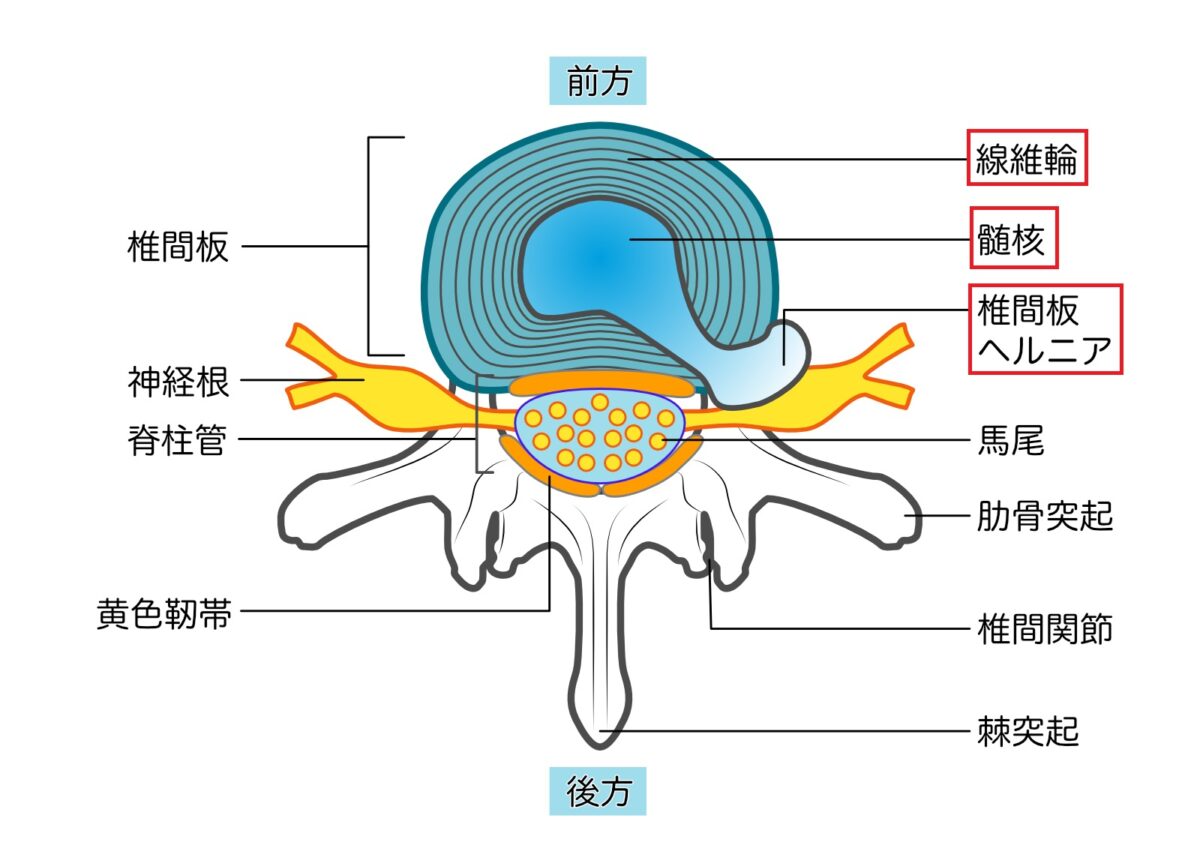 腰椎椎間板ヘルニア　髄核　繊維輪　神経圧迫　