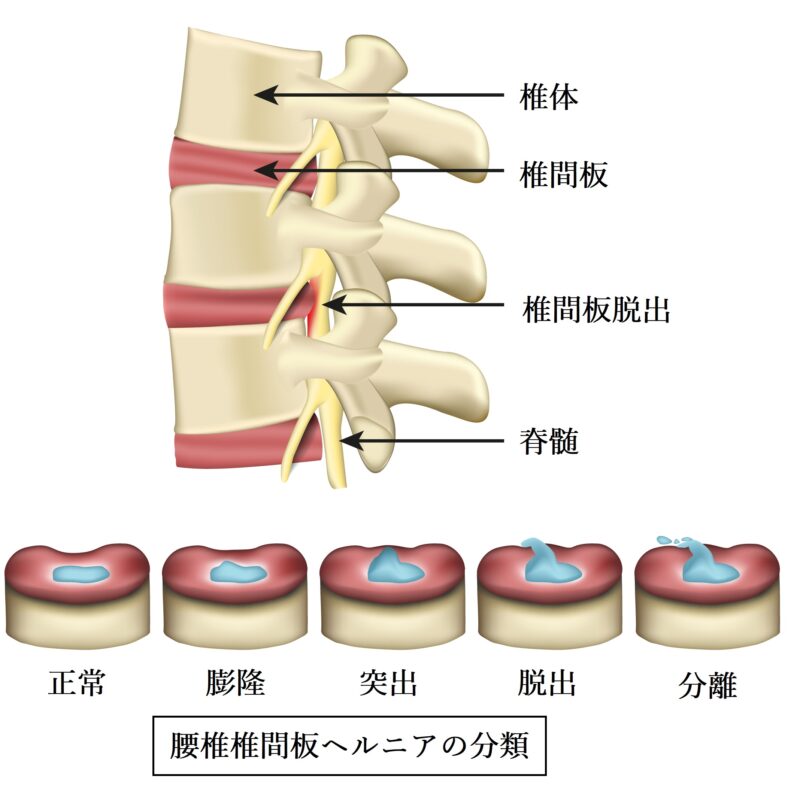 腰椎椎間板ヘルニア　分類　Macnab