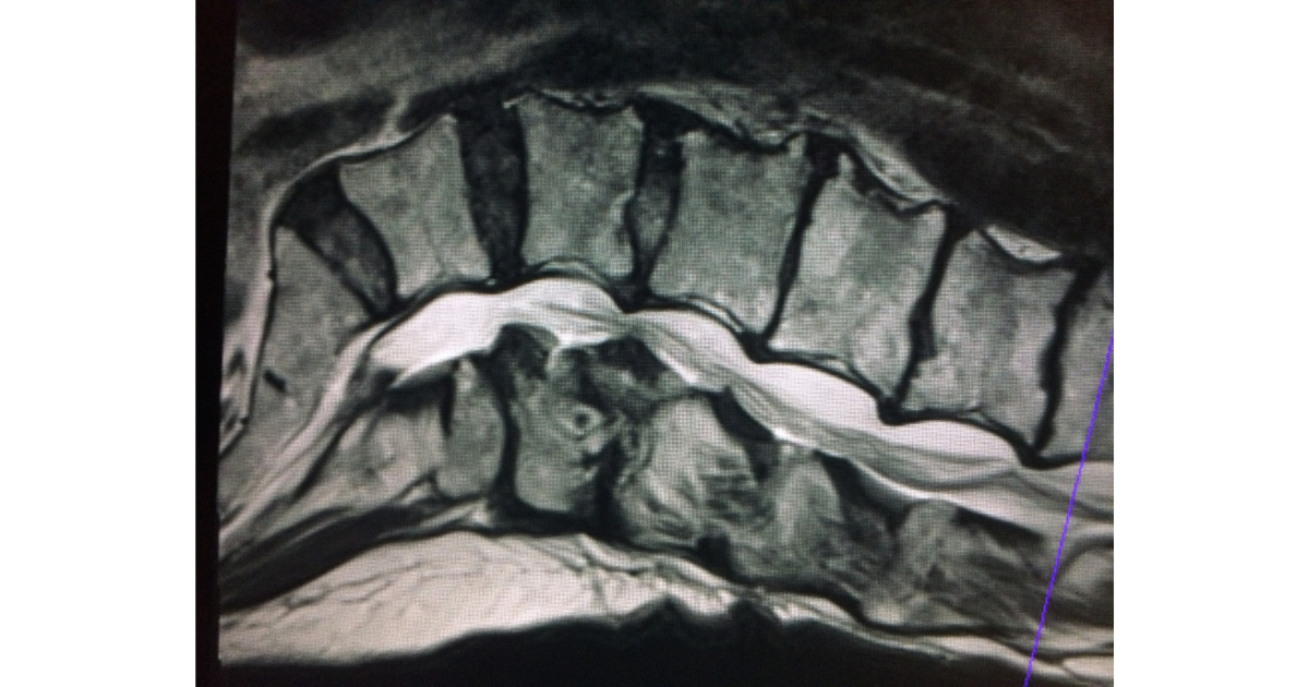 腰部脊柱管狭窄症　画像診断　MRI
