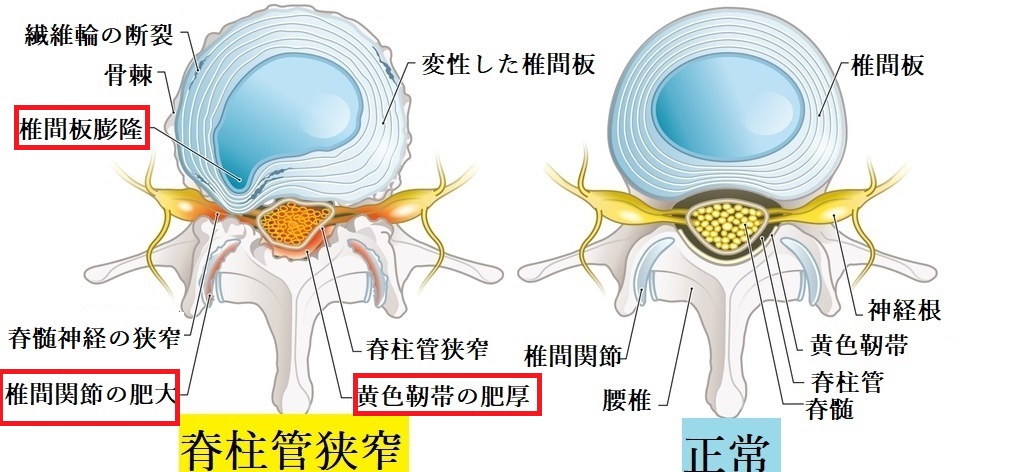 腰部脊柱管狭窄症　分かりやすく説明　図