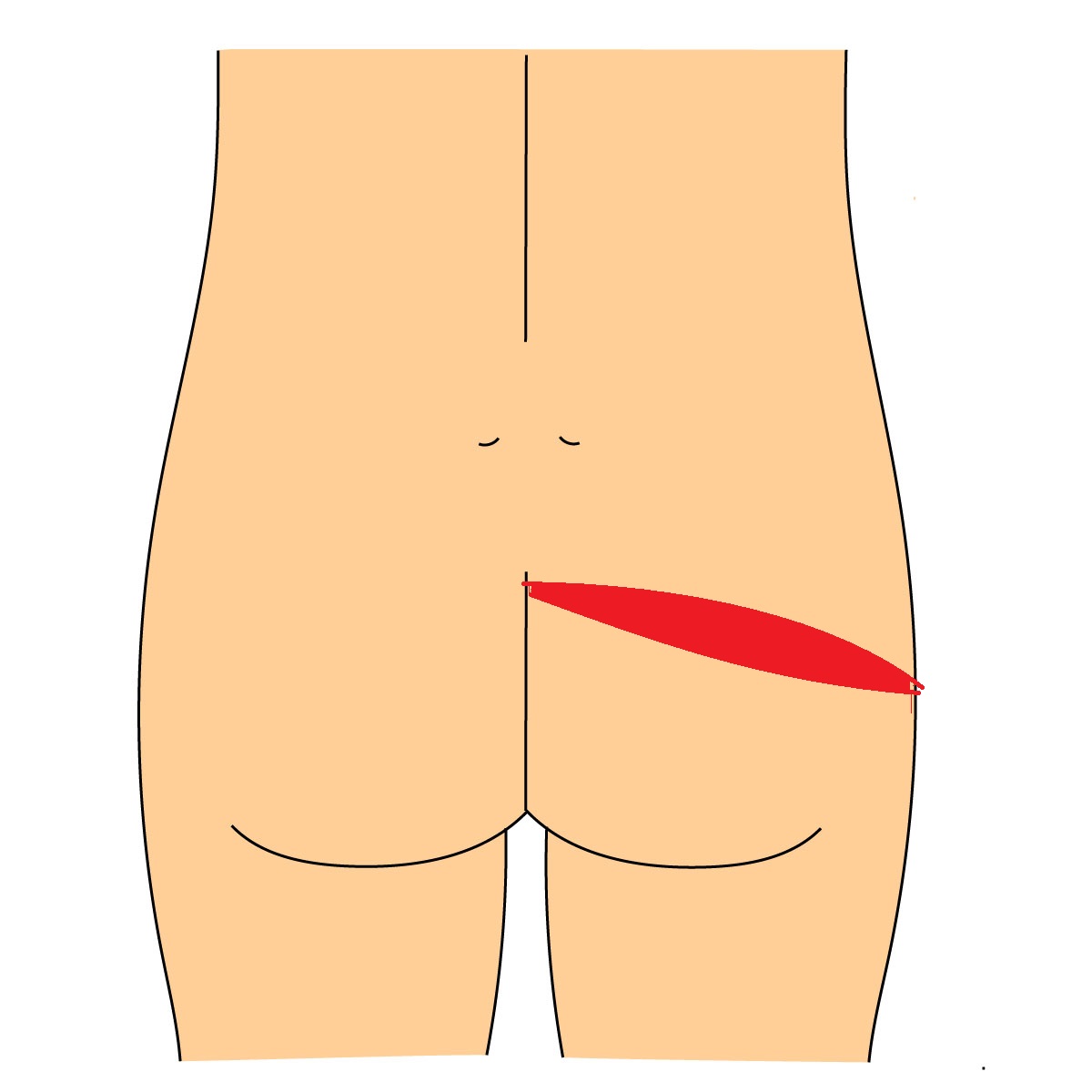 臀部痛　梨状筋症候群　場所の説明　図